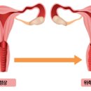 여자 질염 종류 원인 냉 피 냄새 초기 증상 약 치료 (위축성,세균성, 칸디다, 트리코모나스) 이미지