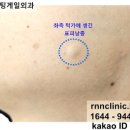 장미꽃과 나이팅게일 피부과의원 | 낭종 제거_초진 및 제거술 예약 후기: [장미꽃과 나이팅게일 외과의원](2025년도 예약은 벌써 마감됨..)