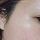 레이저솔루션 | 피부과화장품 추천 더마솔루션 EGF 리젠셀크림 레이저 치료 후 재생크림 후기