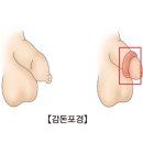 감돈포경 (﻿Paraphimosis) 이미지