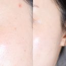 동아광학 | 올리브영 추천템, 바르는 피부제 동아제약 프로 색소침착, 아크네 전문가 사용 TIP!