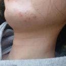 디엠약국 | 독일에서 피부과(Privatarzt) 가본 후기 &amp; 피부 뒤집어짐 회복기...🤦‍♀️