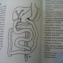 Duodenal Switch(DS) 이미지