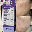 CU성남바른점 | 분당 야탑 바른세상병원 BS피부미용클리닉 할인 이벤트 l 잡티,사마귀,점 제거 레이저 시술 후기