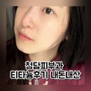 청담동 | 청담동피부과 티타늄리프팅 후기 | 효과 유지기간 이 정도였다고?