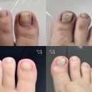 [대구내성발톱]김혜진네일 앤 풋시스 솔직후기 / 내성발톱치료 / 무좀치료 / 발각질관리