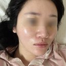 제1산소(의료용산소판매업) | 청담 줄기세포 피부재생주사 2주차 솔직 후기! 아쿠아글로우 PPP 고압산소치료까지 한 번에