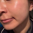 (주)웨이브서클 | 팔자주름 없애기 스킨부스터 쥬브아셀 힐로웨이브 시술 2주차 후기