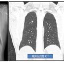 폐암 증세 초기 증상 부터 말기증상 까지, 꼭 알아야 할 증상 정리 이미지