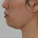 민앤민 | 여드름피부와 이중턱 제거 시술 M씨의 후기: 민앤민의원 티타늄리프팅 &amp; M샤인주사EX