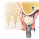 포천외과의원 | 잇몸뼈가 얇아도 괜찮아요! 얇은뼈 임플란트 식립케이스