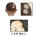두부 백선