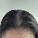 두드림 | 두드림 모발이식 1000모 후기 2편