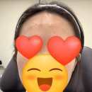 동백피부과의원 | [용인/기흥구/동백]메이퓨어 의원 피부과 이마 보톡스 후기