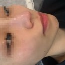 151 | [익산 피부샵] 결뷰티 : esv10 모공디톡스 후기