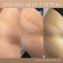보강메디칼 | 살색타투 흉터타투 상처타투 흉터커버업 살색커버업 " 메디컬 스킨타투 " 🩺
