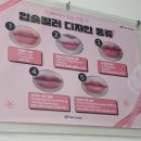 천안 불당동 온리영의원 입술필러 맞은 후기
