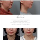 프라이브성형외과의원 | 대구리프팅시술, 울쎄라 VS 써마지 VS 실리프팅? 어떤 게 좋나요?