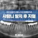 수성구사랑니 사랑니발치후지혈 방법 피가 계속 난다면