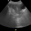 Endometrioma of ovary 이미지