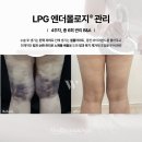 아쥬르의원 | 다산 지방흡입 후 바본관리는 LPG엔더몰로지로!(아쥬르의원 고객님 후기)