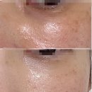 아이멍 | 아이크림보다 확실한 눈밑에 다크서클 주사 아이공주사 솔직 후기 (멍 붓기 통증)