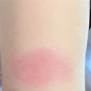 봇들약국 | 19 예방접종 잔여백신 아스트라제네카 1차 접종 후기 21.6.3 오전11시30분 접종부터 3일동안 증상요약