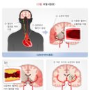 뇌졸중진단비(납입면제시2배보장) 보장 특별약관과 뇌졸중진단비Ⅱ(납입면제시2배보장) 보장 특별약관의 비교 이미지