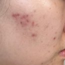 하랑한의원 | [내돈내산]w.피부관리(피부하랑)