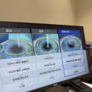 밝음나눔안과의원 | 안양 밝음나눔안과 라식 검안, 수술 후기! + 혜택공유