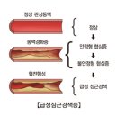 심근경색 전조증상 5가지 이미지