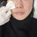 박물관역 1번출구(부산방향) | 부산 화명동 피부과 리투오 잘하는 곳 추천 내돈내산 후기 멍, 통증