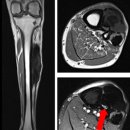 Case_Study_559:종아리에 느리게 자라는 덩어리가 있는 57세 남성_석회화성 근괴사(Calcific myonecrosis)