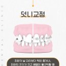 광주교정치과 덧니 교정 꼭 발치해야 되나요