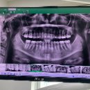 연세사랑나눔치과의원 | 청주 가경동 치과 사랑니 발치 잘하는곳 연세사랑치과 7년 다닌 솔직 후기