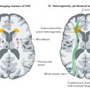 뇌 소혈관질환 cerebral small vessel disease 네이처 리뷰 이미지