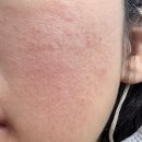 올림 피움 채움 올피채의원 | 강남역피부과 추천 NDA플러스 받은 후기! 올피채강남