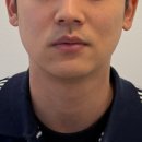 고슴도치한의원 | 내돈내산 스킨보톡스 추천! 압구정 동안침 포함된 온토르패키지 2회차 후기