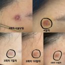 오름한의원 | [내돈내산] 인천 한의원 새살침(오름침) 3회차 후기