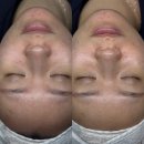 3745 | 셀리올리스킨랩 동탄여드름압출 피부관리 추천 후기