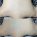 대봉1동행정복지센터 3층 | [대구/중구] 피부나 바디 여드름, 블랙헤드, 색소침착 등을 확실하게 개선하고 싶다면 추천드리는 대구...