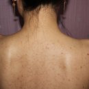 대성한의원 | 모공각화증을 치료를 해율한의원에서는 어떤 방법으로...대구 김규남 원장이 설명드려요 ( 케이스 후기 )