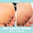 대일수지공업(주) | 레푸스 수지구청 발관리 용인 수지 티눈 제거 후기