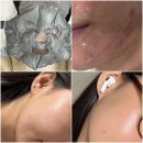 명동미래셀의원 | 명동 루비의원 엑소좀+포텐자 펌핑팁 시술 후기(9cc 4회 시술 효과, 통증)