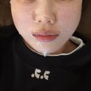 청담서클의원 | 청담 피부과에서 쥬베룩볼륨 앞볼+팔자 귀족부분 내돈내산 솔직후기