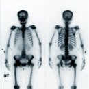 원발 부위 불명암 ( 어디서 시작 됐는지 모르는 암) -골스캔 사진 이미지