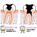 충치치료 재료의 선택과 이해:금 인레이.세라믹인레이.크라운.임플란트.충치치료가격.충치치료비용 이미지