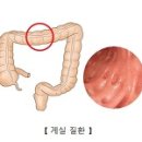 메켈게실 (Meckel's diverticulum) 이미지