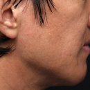 Onward | 연신내피부과 스킨부스터 리투오 2달 차 후기｜가격·부작용·통증