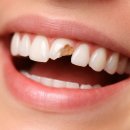 예준치과기공소 | 앞니임플란트가격 기간 얼마나? 명동치과 기준으로 정리